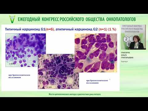 Видео: Место цитологического метода в диагностике рака легкого