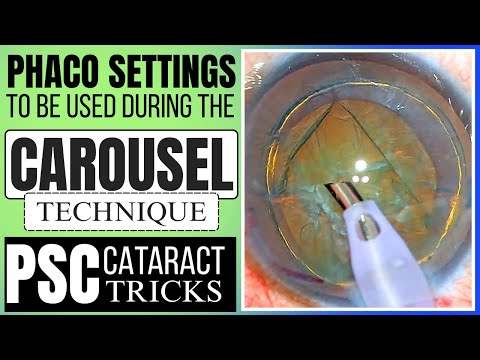 Видео: Метод «карусели» при факоэмульсификации катаракты ПСК и понимание настроек факоэмульсификации — д...