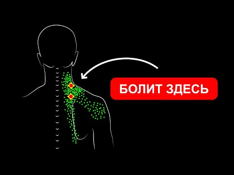 Видео: БОЛИТ ШЕЯ НЕ МОГУ ПОВЕРНУТЬ ГОЛОВУ 🔴 МЫШЦА, ПОДНИМАЮЩАЯ ЛОПАТКУ