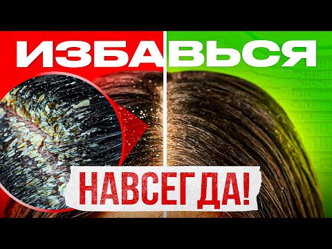 Видео: Перхоть. 5 причин перхоти. Избавься от перхоти навсегда!