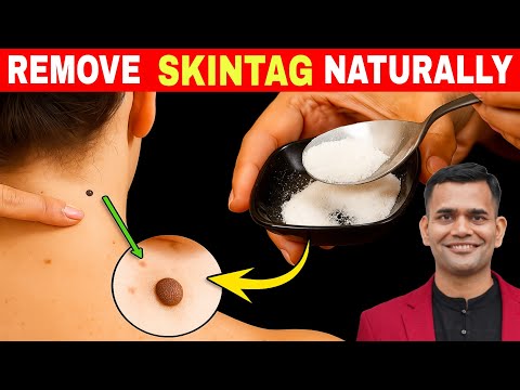 Видео: 1 простой способ быстро избавиться от папиллом и родинок — доктор Вивек Джоши
