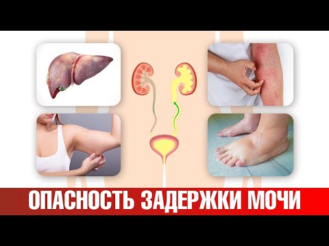 Видео: Задержка мочи опасна для здоровья! 📢 Решить проблему можно.