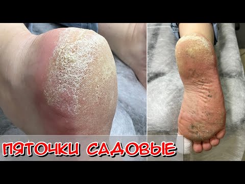 Видео: Глубокие трещины / #Кератоз / #Трещины на пятке / #Потрескались пятки / #Подология