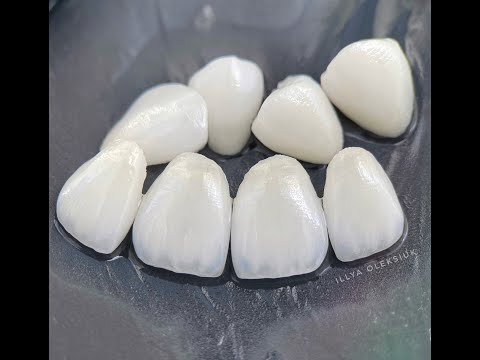 Видео: Feldspathic Veneers on refractory виниры зубной техник dental technician