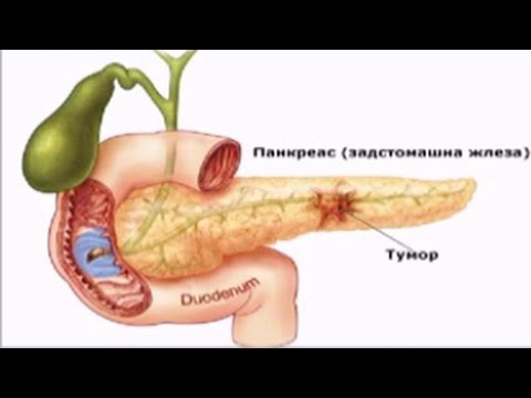 Видео: Академия "Здравословно": Възпалениена задстомашната жлеза (панкреатит)