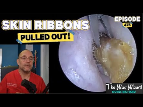 Видео: КОЖНЫЕ ЛЕНТЫ ВЫДЕРНУЛИ ИЗ УХА! Эпизод 475