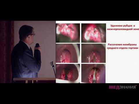 Видео: 08 Эндоларингеальная микрохирургия хронических стенозов гортани и трахеи