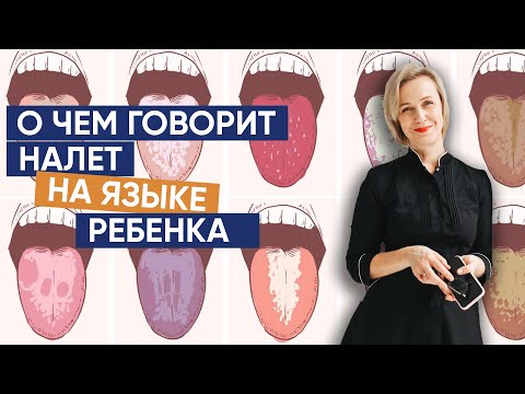 Видео: О чем говорит налет на языке ребенка