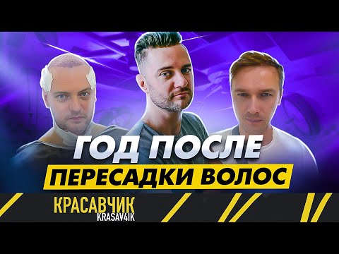 Видео: Результаты спустя год после пересадки волос | Насколько твоя жизнь может измениться | KRASAV4IK