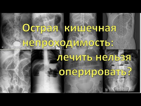Видео: Острая кишечная непроходимость: лечить нельзя оперировать