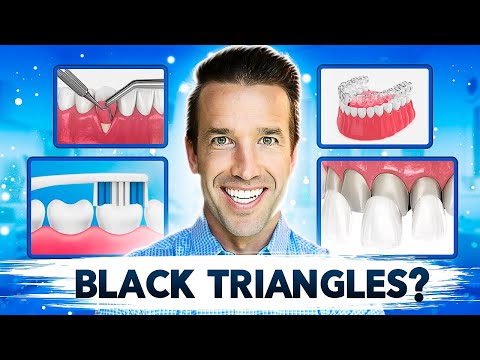 Видео: Как избавиться от чёрных треугольников | Проблемы с дёснами