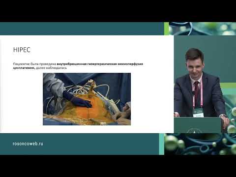 Видео: Лечение муцинозного рака яичников. Разбор клинического случая
