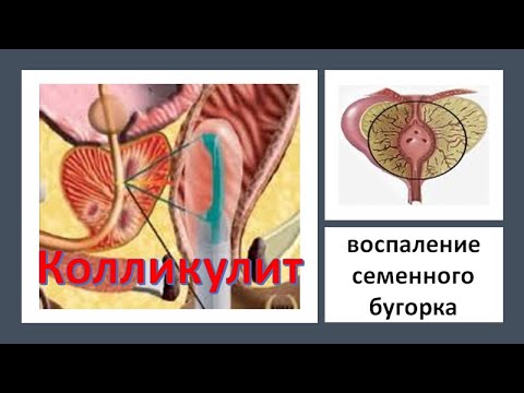 Видео: Колликулит. Лечение колликулита