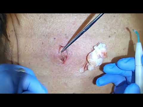 Видео: Удаление атеромы спины, дренирование