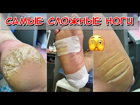 Видео: Самые сложные ноги / Кератоз пяток / Огрубевшие пятки / Трещины на пятках / Педикюр