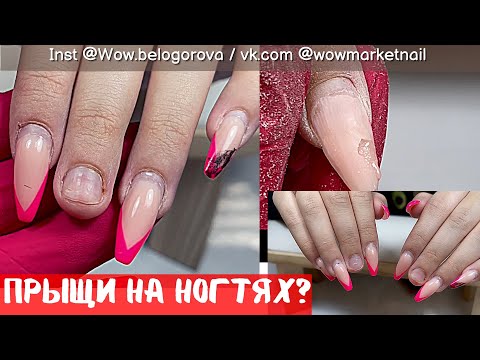 Видео: Прыщи на ногтях😱| Не досушили гель, что делать? Ходила так целый месяц! Коррекция| Наращивание