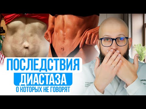 Видео: ПОСЛЕДСТВИЯ ДИАСТАЗА о которых молчат Фитнес тренера и доктора. Тест на Диастаз