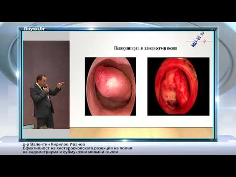 Видео: Ефективност на хистероскопската резекция на полип на ендометриума и субмукозни миомни възли