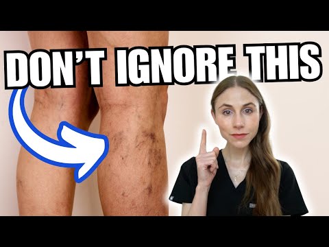 Видео: Хроническая венозная недостаточность: что ваши ноги пытаются вам сказать