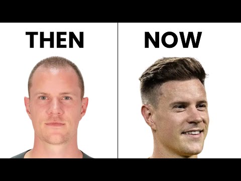 Видео: Пересадка волос Тер Штегена 1,5 года спустя