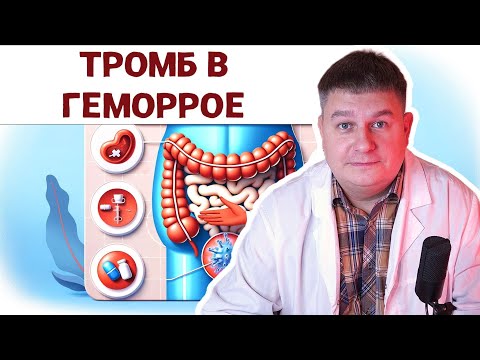 Видео: Шишка в области заднего прохода: мифы и факты