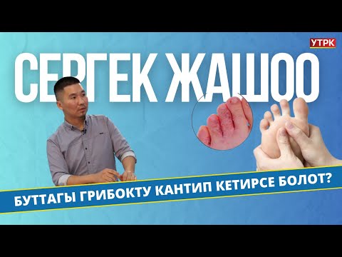 Видео: Буттагы грибокту кантип кетирсе болот? | Сергек жашоо