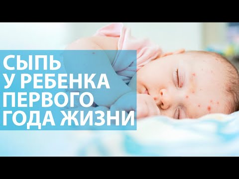 Видео: Сыпь у ребёнка до года