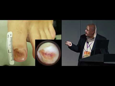 Видео: Сложности клинической диагностики меланомы кожи