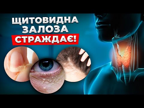 Видео: ПРИХОВАНІ СИМПТОМИ СЕРЙОЗНИХ ПРОБЛЕМ! Причини та методи лікування щитовидної залози!