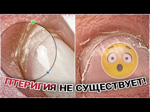 Видео: 😱Птеригия не существует!😨
