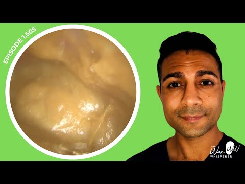 Видео: 1,505 - Сложная и трудная чистка ушей