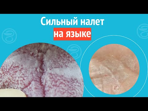 Видео: 👅 Сильный налет на языке. Клинический случай №1693