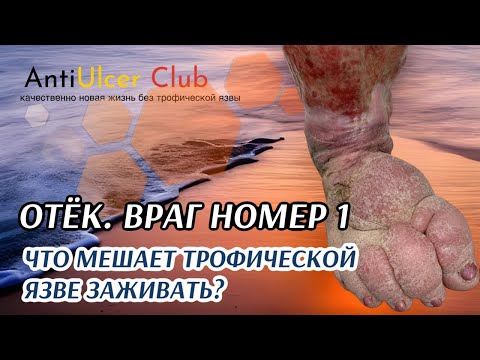 Видео: Почему язвы на ноге не заживают. Враг номер 1, мешающий заживлению.