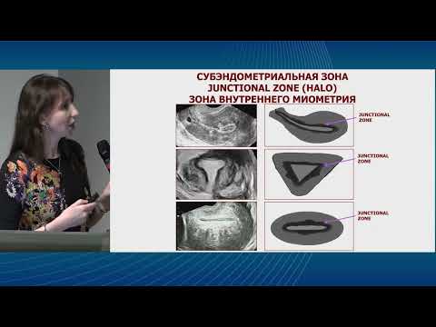 Видео: Ультразвуковая диагностика аденомиоза. Есипова И.А.