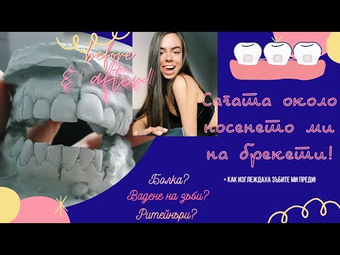 Видео: Сагата около носенето ми на БРЕКЕТИ! (+ как изглеждаха зъбите ми преди)