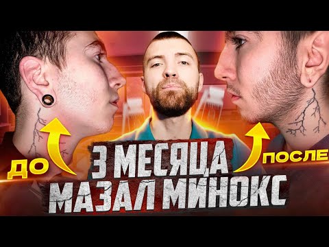 Видео: Минокс#### результаты за 3 месяца. Андрей Борода Выпуск №17 как запустить рост бороды