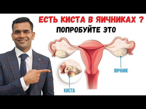 Видео: Есть Киста В Яичниках? Попробуйте Это | Доктор Вивек Джоши
