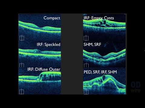Видео: Интерпретация макулярной ОКТ: практическое обсуждение с доктором Дэвидом Э. Ледерером