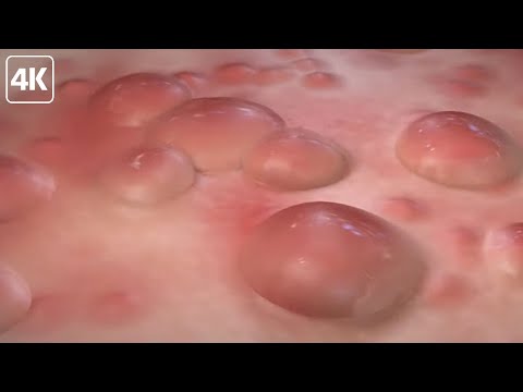 Видео: Оспа обезьян - пора бить тревогу?