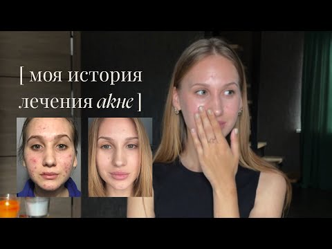 Видео: КАК Я ВЫЛЕЧИЛА АКНЕ путь длиною в 6 лет | системные ретиноиды, комплексы и кожа сейчас