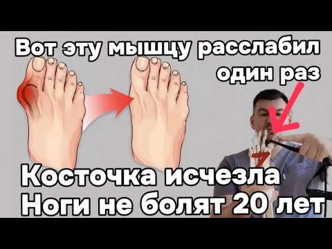 Видео: Косточка на стопе исчезает навсегда. Расслабил эту мышцу и ноги не болят уже 20 лет