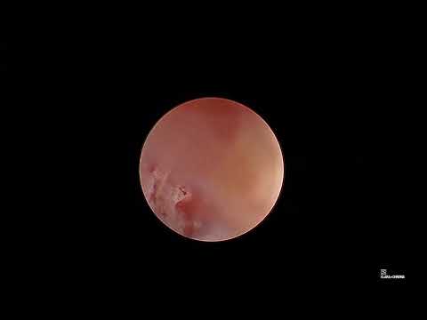 Видео: отоскопия чихуа, хронический средний отит