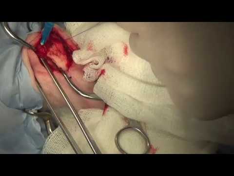 Видео: TPLO при разрыве передней крестовидной связки у карликовых пород собак