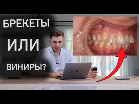 Видео: ИДЕАЛЬНАЯ УЛЫБКА БЕЗ БРЕКЕТОВ. ВИНИРЫ