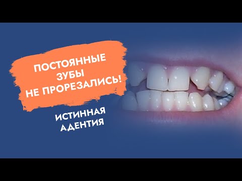 Видео: Постоянные зубы не прорезались. Истинная адентия.