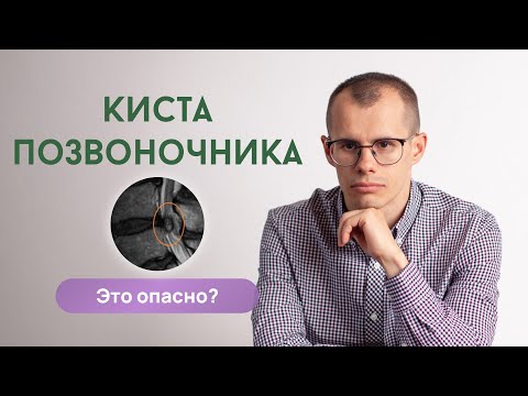 Видео: Киста позвоночника. Параартикулярная киста. Это опасно?