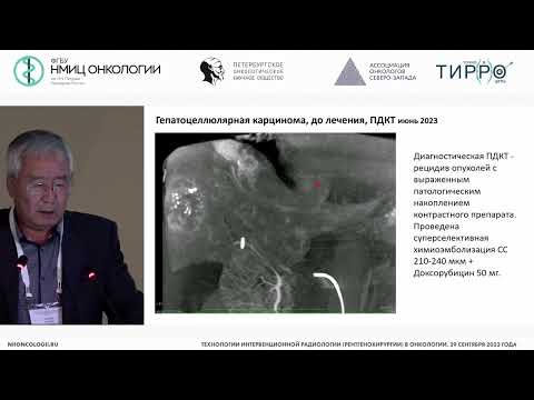 Видео: Опыт использования отечественных лекарственно-насыщаемых микросфер для химиоэмболизации первичных
