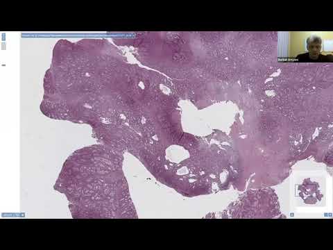 Видео: Полипы желудка