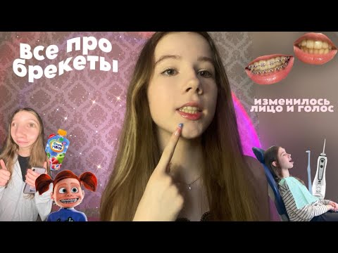 Видео: 🦷ЭТО НУЖНО ЗНАТЬ ПЕРЕД УСТАНОВКОЙ БРЕКЕТОВ! изменилось лицо, советы, боль