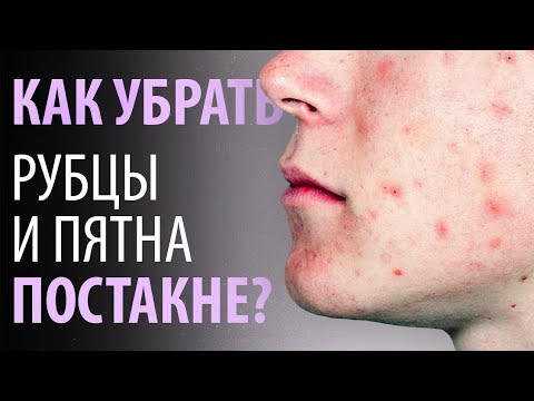 Видео: Постакне. Причины. Как убрать?